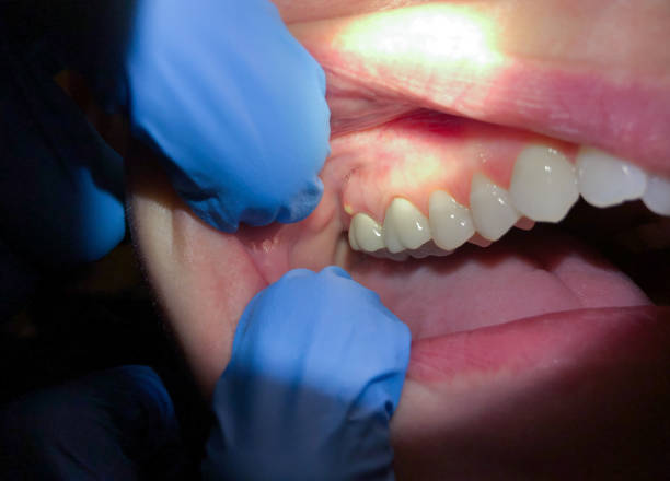 Best Emergency Care for Gum Disease in Gainesville, FL